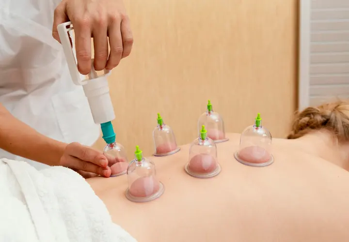 Therapist placing transparent cupping therapy cups along client’s bare upper back