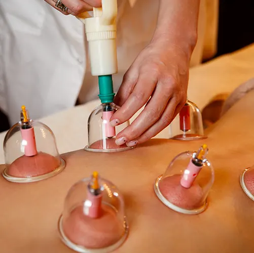 Row of silicone cupping therapy cups creating circular marks on relaxed client’s back